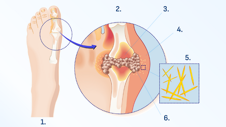 Gout: healthy and affected joint