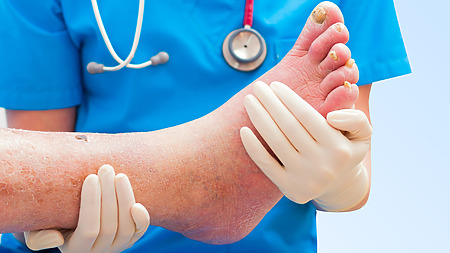 Photo of a diabetic foot