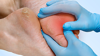 Dry feet can be a harbinger of ulcer formation