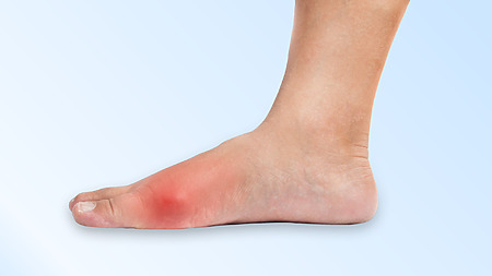 What does gout look like