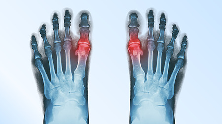 Bottoms of the feet - X-rays are used in the examination