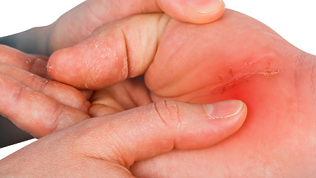 After carpal tunnel surgery, patients have a wrist wound