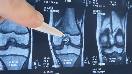 Rheumatic knee - various imaging methods are used in the diagnosis